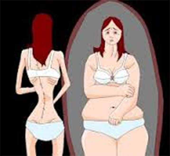 anorexia